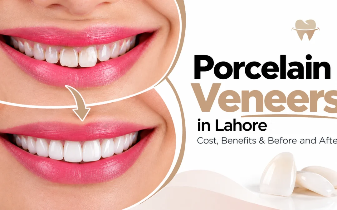 Porcelain Veneers in Lahore: Cost, Benefits & Before and After