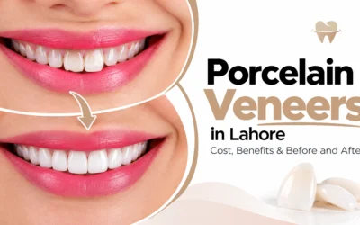 Porcelain Veneers in Lahore: Cost, Benefits & Before and After