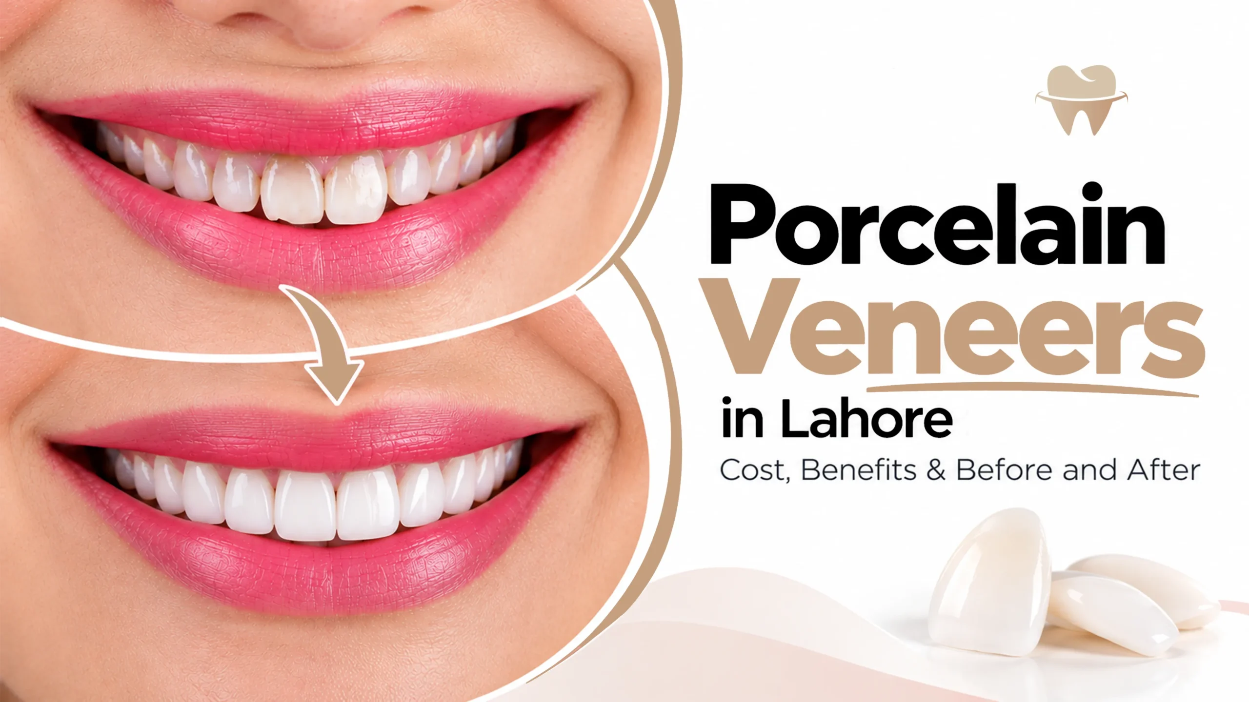 Porcelain Veneers in Lahore Porcelain Veneers in Lahore