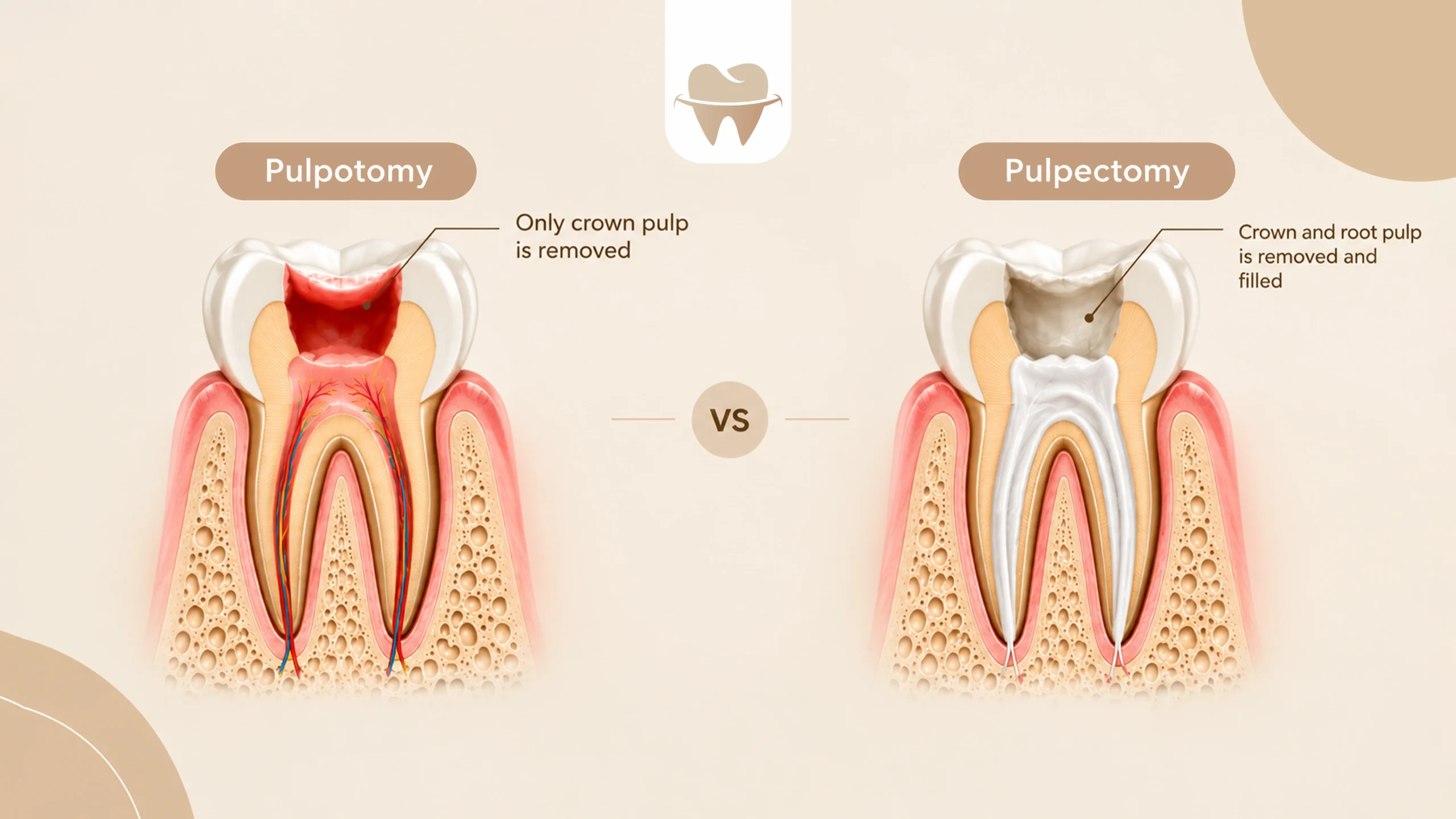 Pulpotomy vs Pulpectomy Pulpotomy vs Pulpectomy